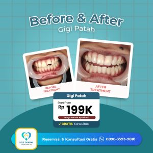 Testimoni Gigi Patah