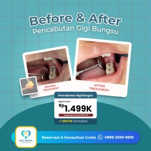 Testimoni Pencabutan Gigi bungsu