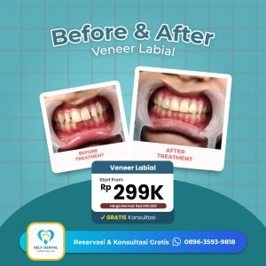 Testimoni Veneer Labial