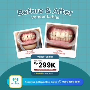 Testimoni Veneer Labial